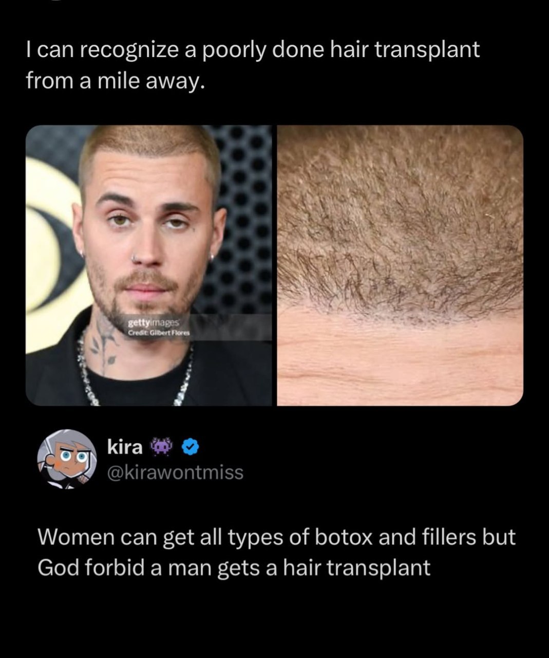 can recognize a poorly done hair transplant from a mile away. 4 А kira @kirawontmiss Women can get all types of botox and fillers but God forbid a man gets a hair transplant