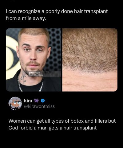 can recognize a poorly done hair transplant from a mile away. 4 А kira @kirawontmiss Women can get all types of botox and fillers but God forbid a man gets a hair transplant
