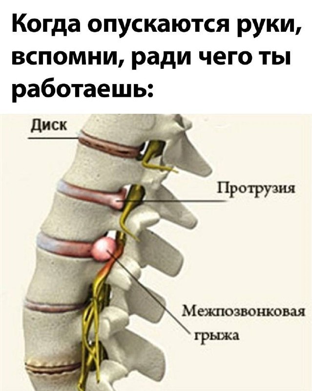 Когда опускаются руки, вспомни, ради чего ты работаешь: Диск 4’. Протрузия A Межпозвонковая 4 грыжа
