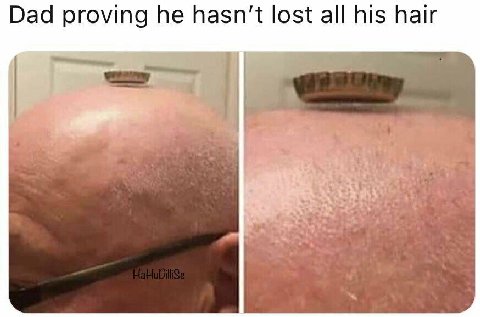 Dad proving he lost all his hair