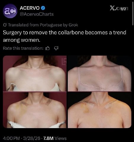 АСЕВУО as @AcervoCharts Translated from Portuguese Grok Surgery to remove the collarbone becomes a trend among women. Rate this translation: 4:00 3/28/26 Views