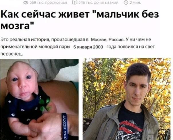 и Как сейчас живет "мальчик без и мозга Это реальная история, произошедшая в Москве, Россия. У ни чем не примечательной молодой пары 5 января 2000 года появился на свет первенец. bes 4