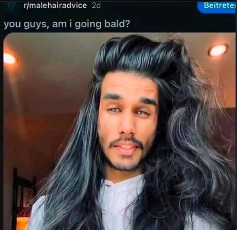 r/malehairadvice Вейгете! you guys, ami going bald? И 4 |1 4