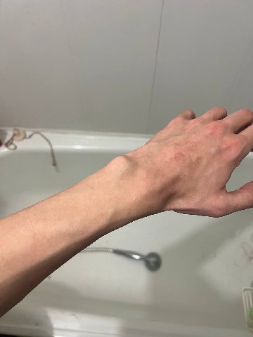 фото. я имульсивно и неумело вчера решил побрить свои руки. Предвосхищая возмущения некоторых из вас хочу напомнить, что бритьё рук это далеко не худшее, что люди в микродепрессии делали со своими рук