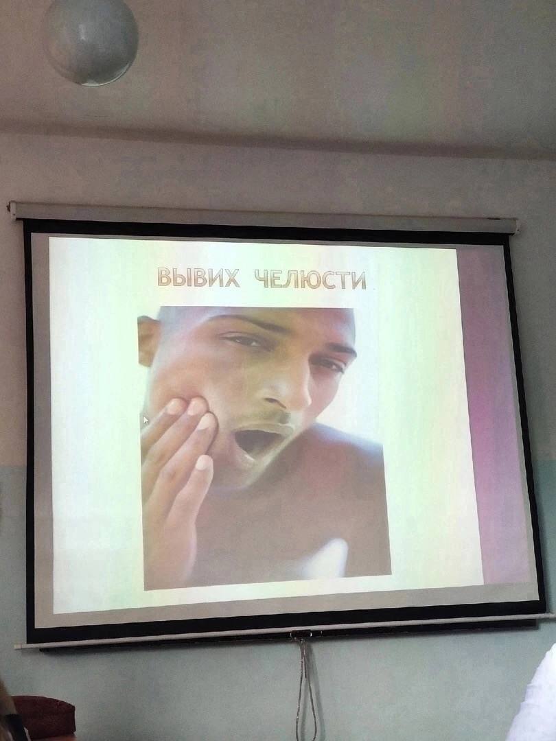 ВЫВИХ ЧЕЛЮСТИ