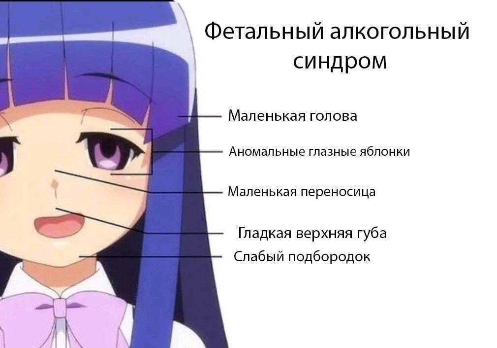 Фетальный алкогольный синдром Маленькая голова Аномальные глазные яблонки Маленькая переносица Гладкая верхняя губа Слабый подбородок