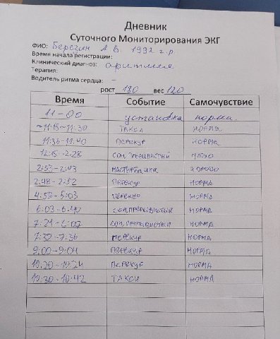 Дневник Суточного Мониторирования ЭКГ ФИО: Время начала ‘регистрации: 2 Клинический диагноз: Терапия: Водитель ритма сердца: _вес Время Событие Самочувствие 11-90 а 12:45 Сон, 6:03 9:00=9:04 19:50 40: