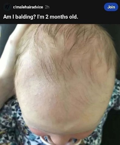 r/malehairadvice Join balding? 2 months old.