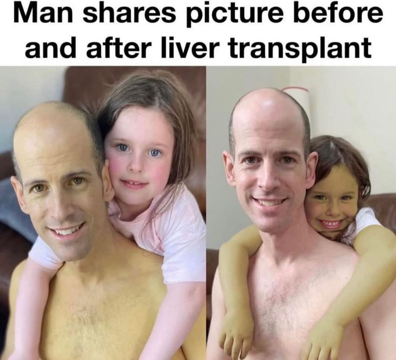 Man shares picture before and after liver transplant