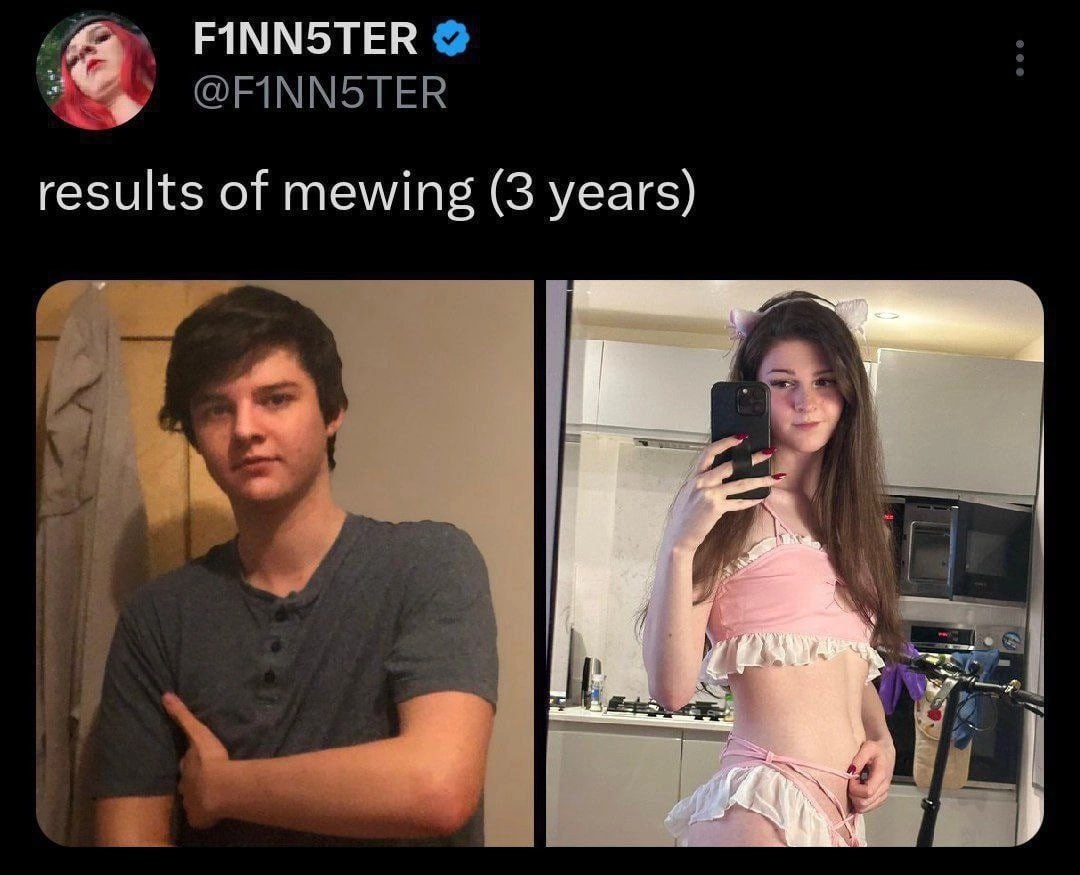 FINNSTER results of mewing (3 years)
