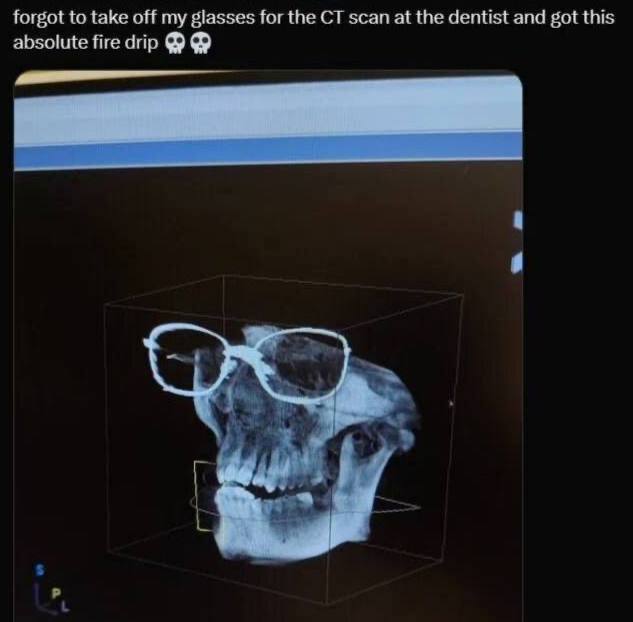 forgot to take off my glasses for scan а the dentist and got this absolute fire drip