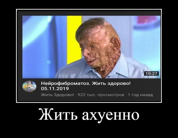 у Нейрофиброматоз. Жить здорово! 05.11.2019 Жить Здорово! 922 тыс. просмотров 1 год назад Жить ахуенно