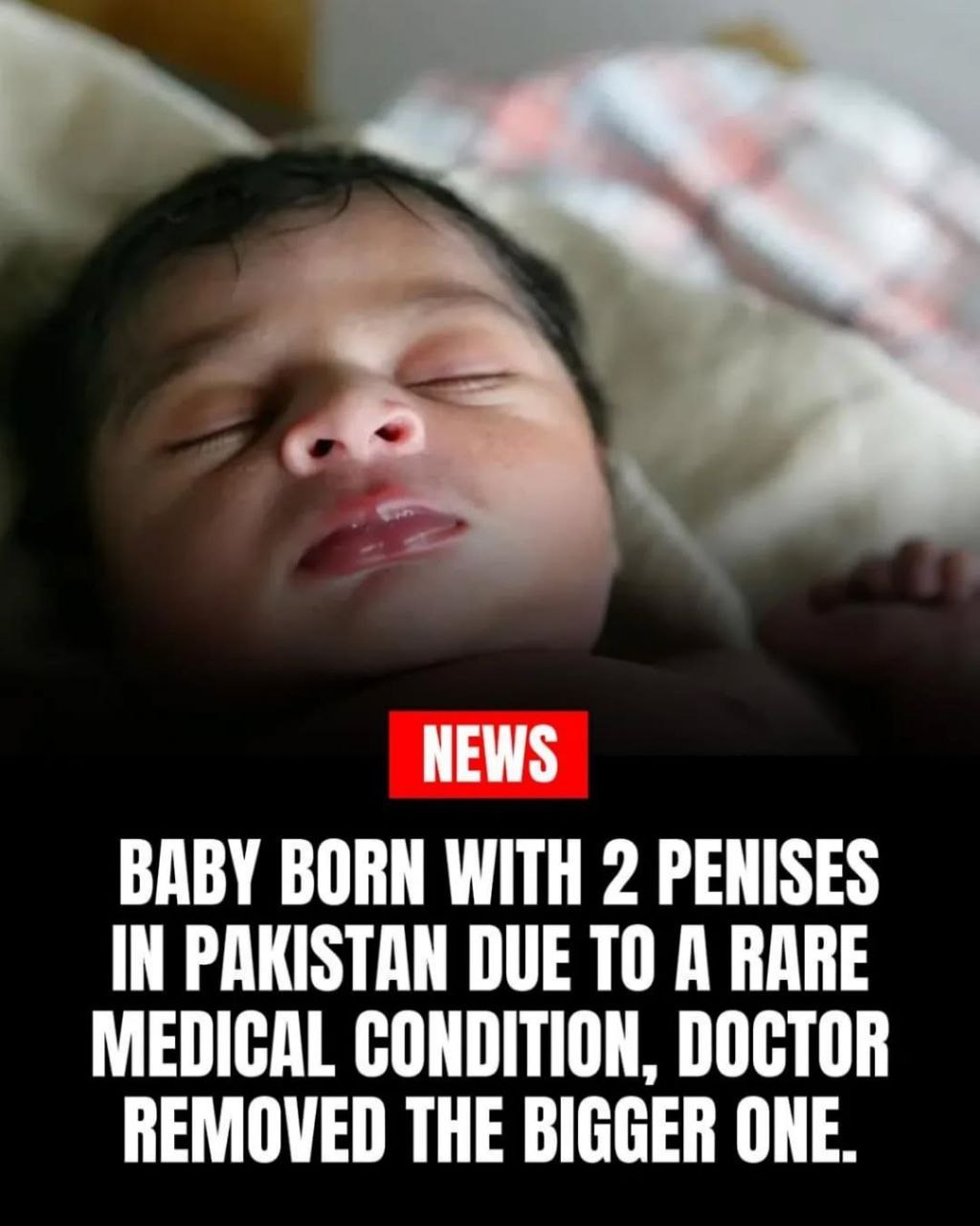 53 NEWS BABY BORN WITH 2 PENISES IN PAKISTAN DUE ТО A RARE MEDICAL CONDITION, DOCTOR REMOVED THE BIGGER ONE.