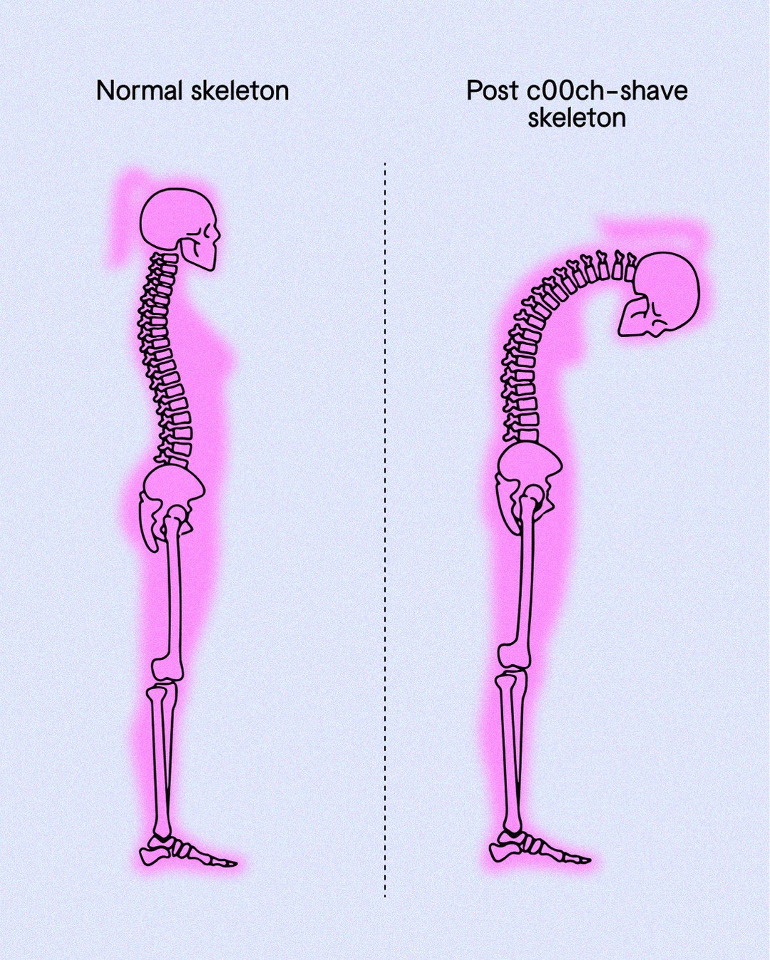 Normal skeleton Post cOOch-shave skeleton