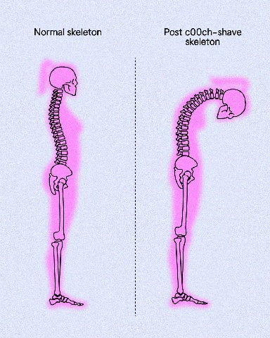 Normal skeleton Post cOOch-shave skeleton