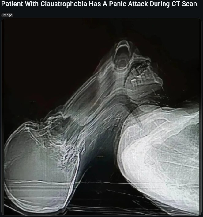 Patient With Claustrophobia Has A Panic Attack During Scan