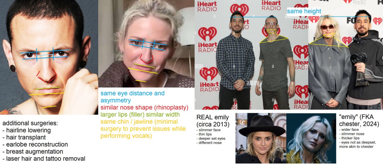 iHeart Неа RADIO height a 7 if iHeai а iHear a RADI wor у 7 a a РАС: a same eye distance and asymmetry iHez A 9 similar nose shape (rhinoplasty) larger lips (filler) similar width REAL emily "emily" (