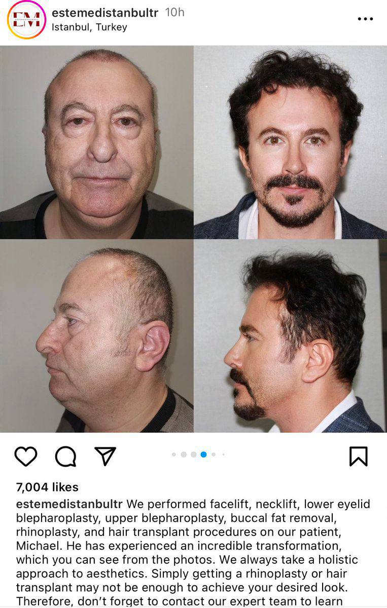 глл\ estemedistanbultr istanbul, Turkey ‘i 4 2 4 4 7 у i а к i 7,004 likes estemedistanbultr We performed facelift, necklift, lower eyelid blepharoplasty, upper blepharoplasty, buccal fat removal, rhi