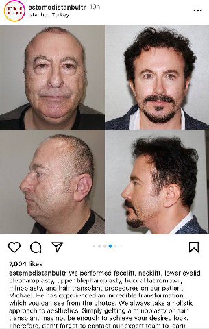 глл\ estemedistanbultr istanbul, Turkey ‘i 4 2 4 4 7 у i а к i 7,004 likes estemedistanbultr We performed facelift, necklift, lower eyelid blepharoplasty, upper blepharoplasty, buccal fat removal, rhi