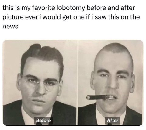 this is my favorite lobotomy before and after picture ever i would get one if i saw this on the news 3 Before After