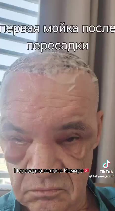 к @ tatyana_izmir А р 'пересал Пересадка волос в Измире TikTok пеовая мойка\после КПШересадка|волосвИзмирее м
