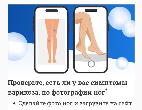 О Проверьте, есть ли у вас симптомы варикоза, по фотографии Hor Сделайте фото ног и загрузите на сайт