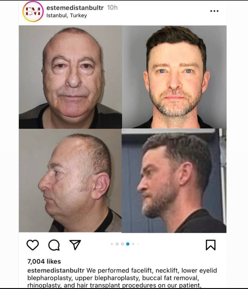 a estemedistanbultr eee Istanbul, Turkey i Be 7,004 likes estemedistanbultr We performed facelift, necklift, lower eyelid blepharoplasty, upper blepharoplasty, buccal fat removal, rhinop lasty, and ha