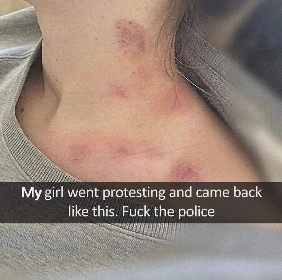 My girl went protesting and came back like this. Fuck the police