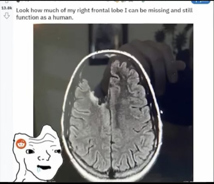 Look how much of my right frontal lobe I can be missing and still function as a human. 2 729 the