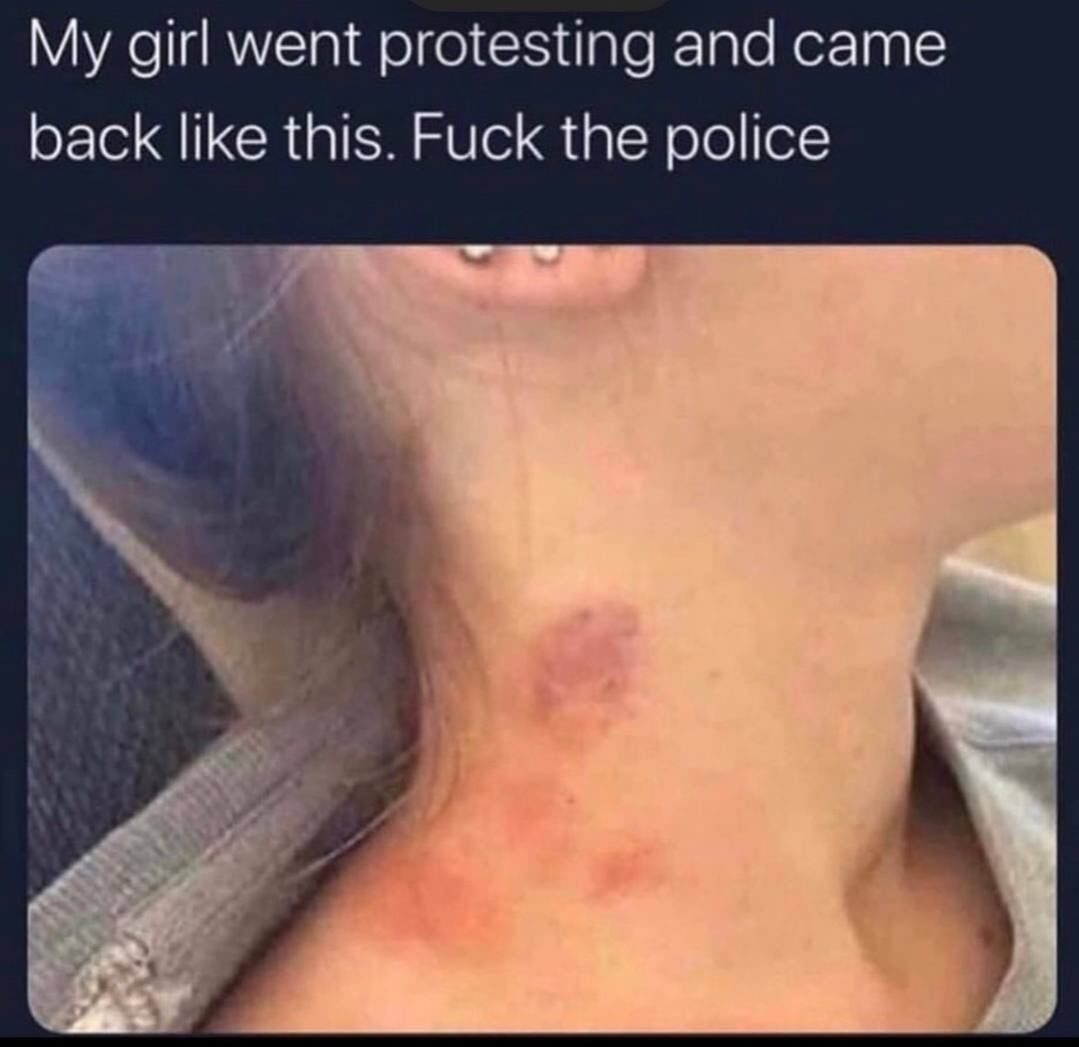 girl went protesting and came back like this. Fuck the police