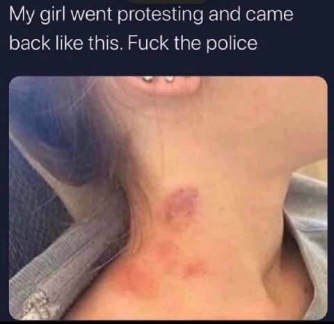 girl went protesting and came back like this. Fuck the police