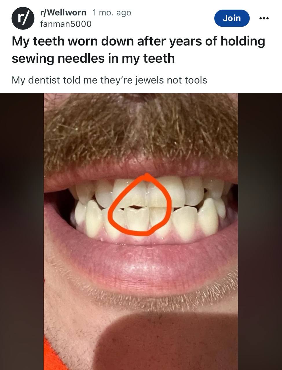 r/Wellworn 1 то. ago fanman5000 My teeth worn down after years of holding sewing needles in my teeth My dentist told me jewels not tools @4