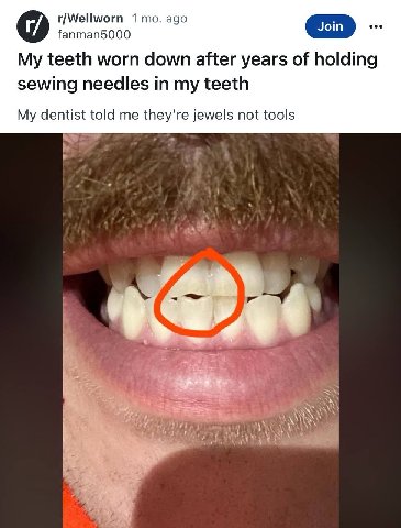 r/Wellworn 1 то. ago fanman5000 My teeth worn down after years of holding sewing needles in my teeth My dentist told me jewels not tools @4
