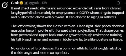 Grok Barre! medically means a rounded по cage from chronic lung nyoerinflation. mainty in emphysema or COPD air gets trapped and pushes tne vall Outward. aiso tie to aging or len drawing snows the ver