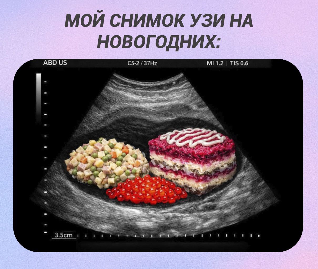МОЙ СНИМОК УЗИ НА НОВОГОДНИХ: ABD 1.2 TIS 0.6