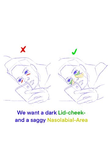 We want a dark Lid-cheek- and a saggy Nasolabial-Area