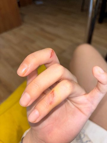 короче заживает это дело очень болезненно + не могу без боли в ране полностью согнуть палец
вот единственный консерн на тему не может ли оно в итоге зарубцеваться так, что я в принципе их не смогу сги