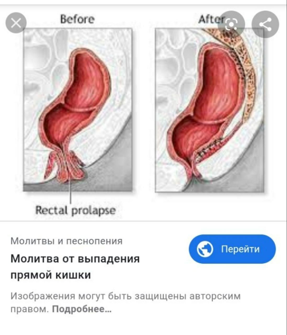 15 Rectal prolapse Молитвы и песнопения Молитва от выпадения прямой кишки Изображения могут быть защищены авторским правом. Подробнее...