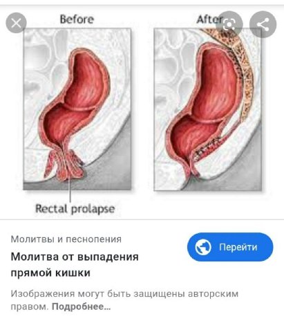 15 Rectal prolapse Молитвы и песнопения Молитва от выпадения прямой кишки Изображения могут быть защищены авторским правом. Подробнее...