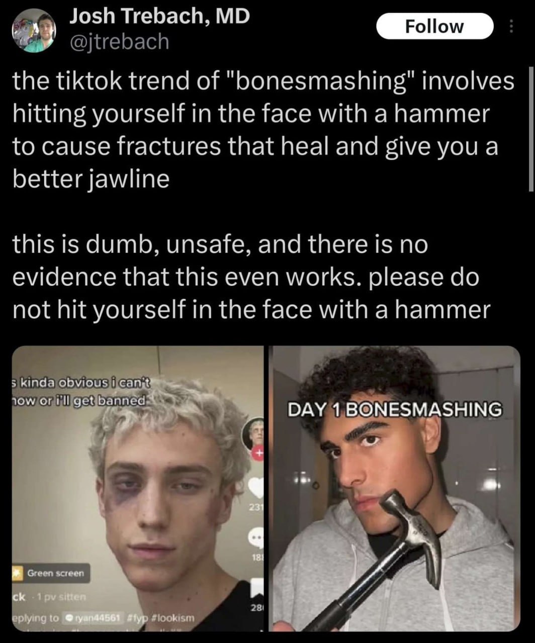 ли Josh Trebach, the tiktok trend of involves hitting yourself in the face with a hammer to cause fractures that heal and give you a better jawline this is dumb, unsafe, and there is no evidence that 