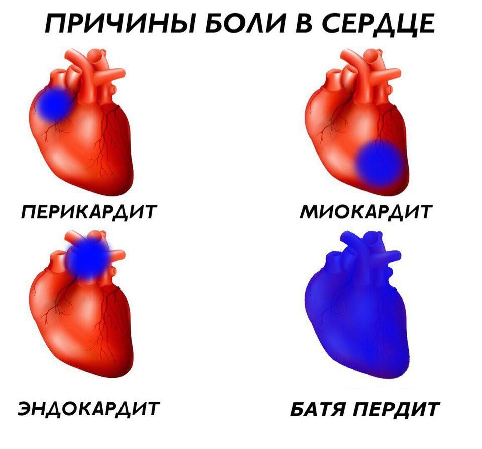 ПРИЧИНЫ БОЛИ В СЕРДЦЕ ПЕРИКАРДИТ МИОКАРДИТ ЭНДОКАРДИТ БАТЯ ПЕРДИТ