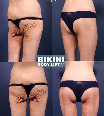 BIKINI LIFT