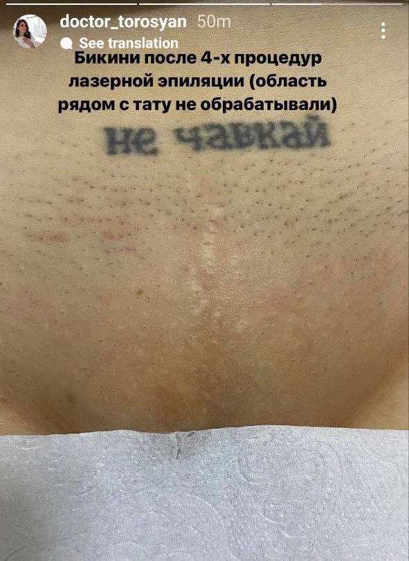 после процедур лазерной эпиляции (область рядом с тату не обрабатывали) 5 у у