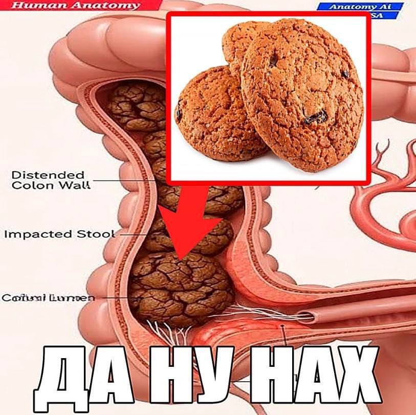 At $2 Distended Colon Watt Impacted о