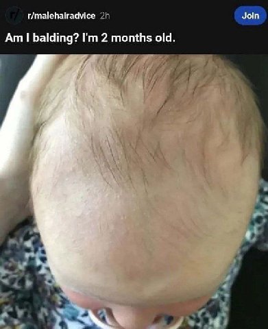r/malehairadvice Join balding? 2 months old.