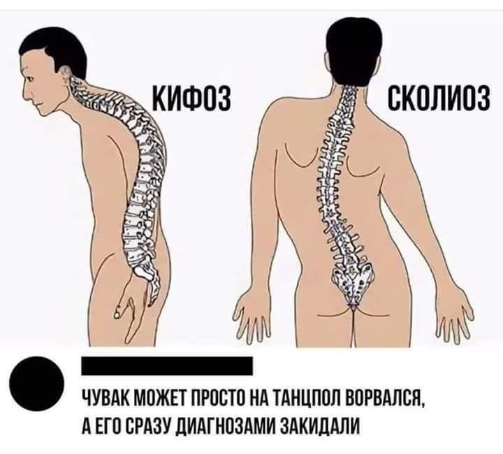 КИФОЗ СКОЛИОЗ 5 ЧУВАК МОЖЕТ ПРОСТО НА ТАНЦПОЛ ВОРВАЛСЯ, АЕГО СРАЗУ ДИАГНОЗАМИ ЗАКИДАЛИ