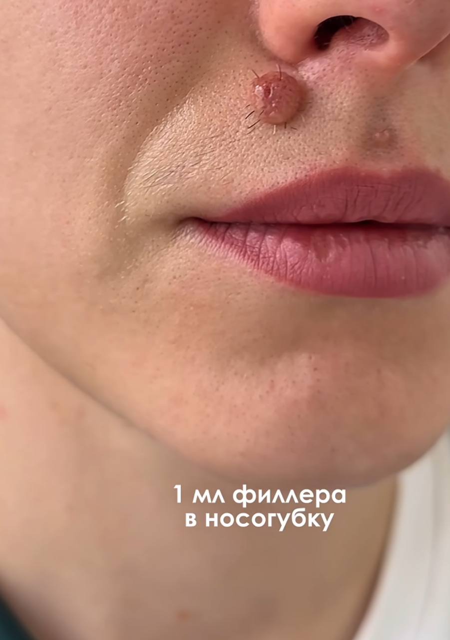 1 филлера в носогубку