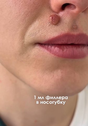 1 филлера в носогубку
