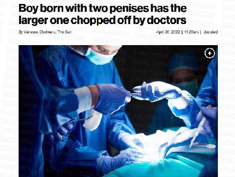 Boy born with two penises has the larger one chopped off doctors Vanessa Chalmers, The Sun April 20, 2022 Updated 9