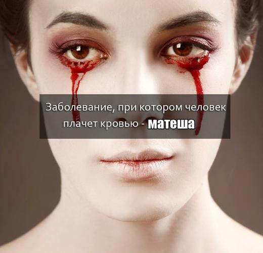 Заболевание, при котором человек плачет кровью Матеша